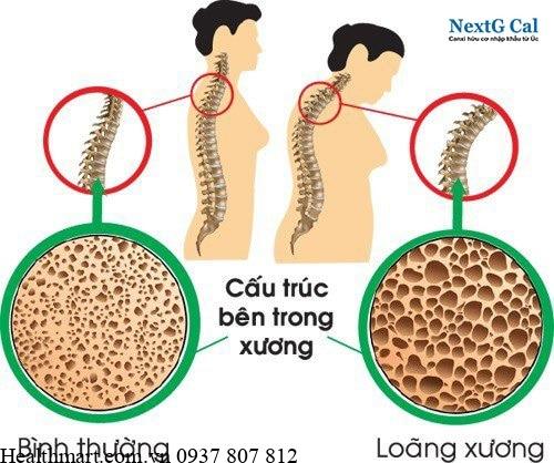 Bone Mas chỉ số khối lượng xương là gì, cách cải thiện 1